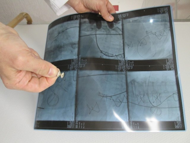 В Челябинске кардиохирурги провели операцию по ликвидации отверстия, образовавшегося рядом с имплантированным клапаном сердца